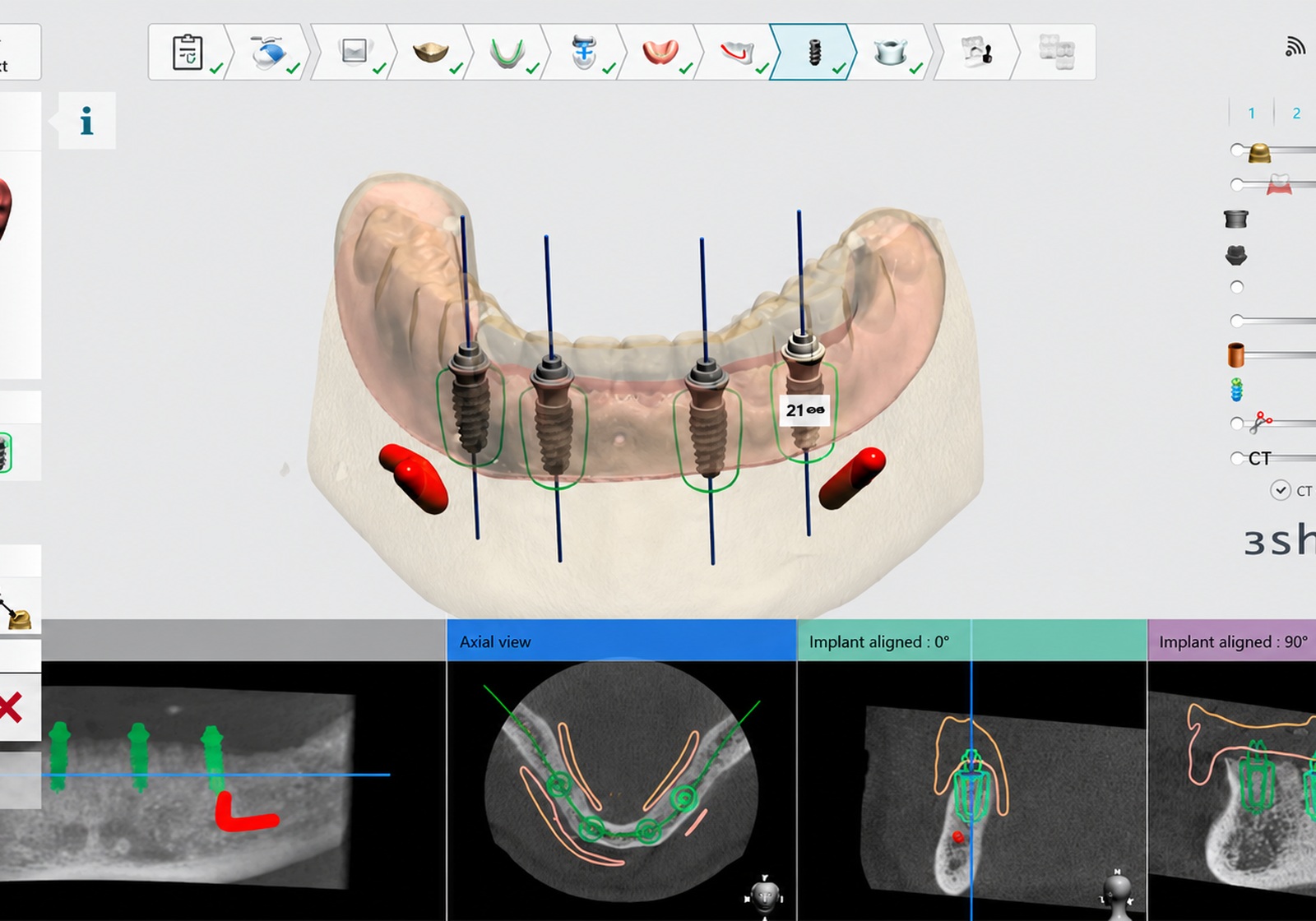 Implant planning