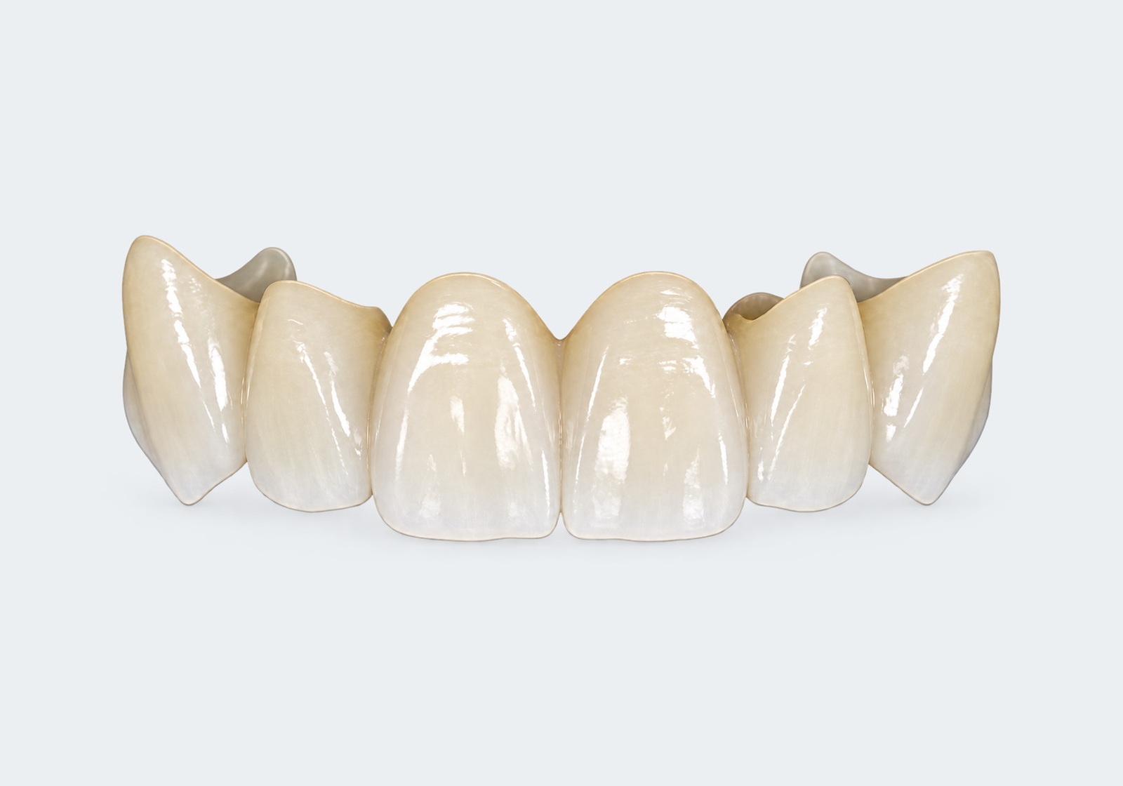 Anterior zirconia bridge