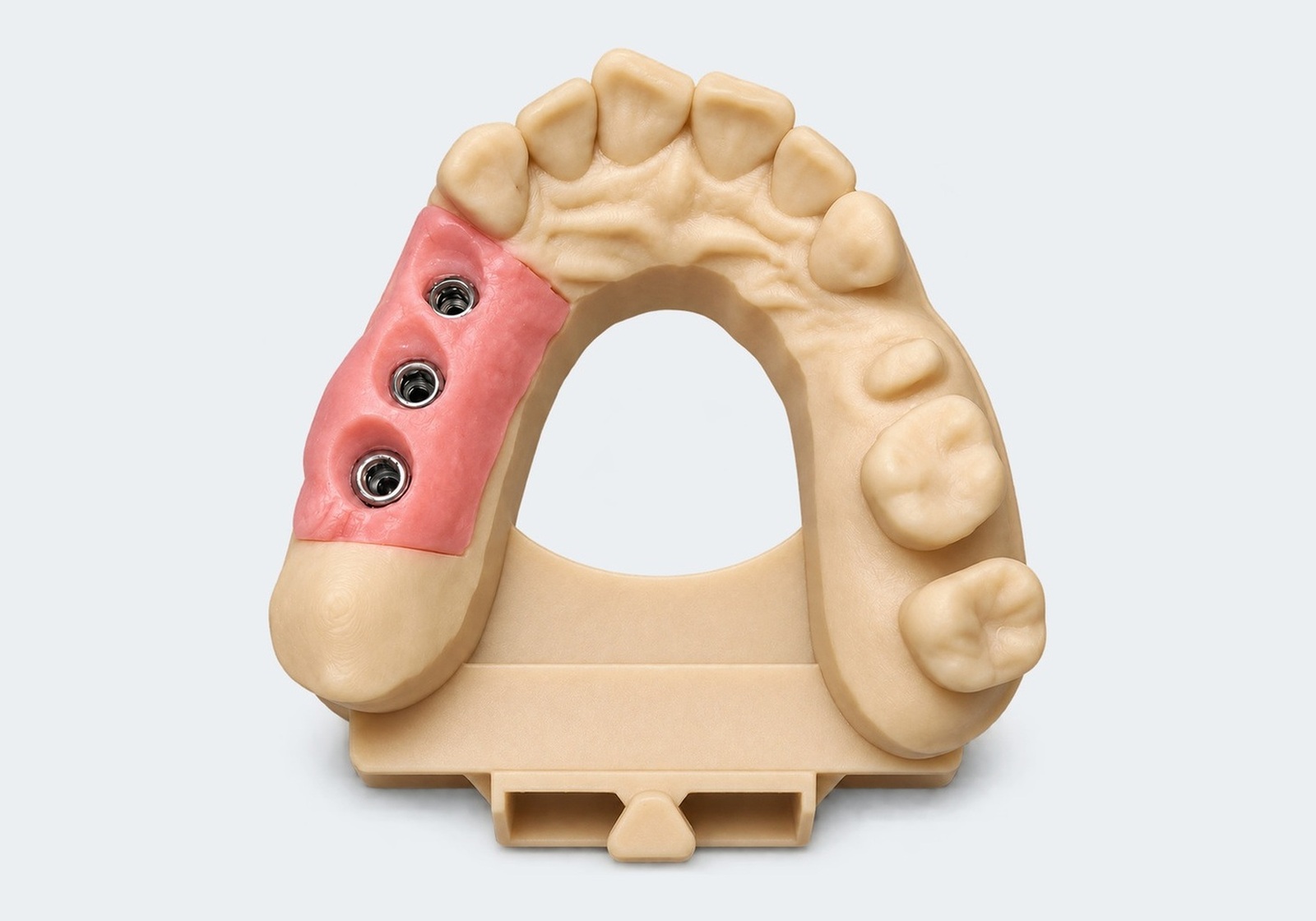 3D printed implant models