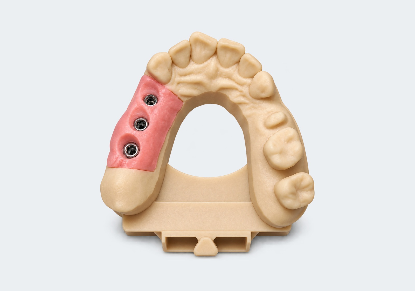 3D printed implant model.