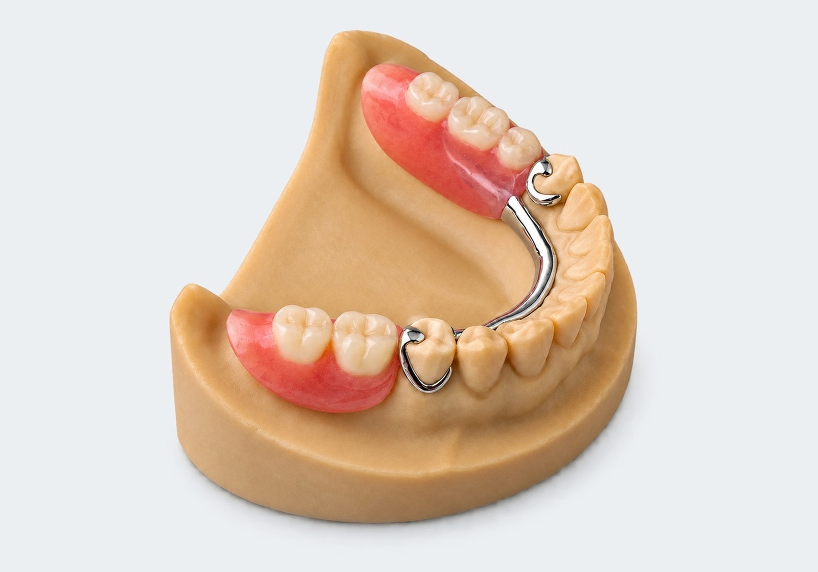 Cast metal partial denture